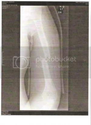 Brokenhumerus2