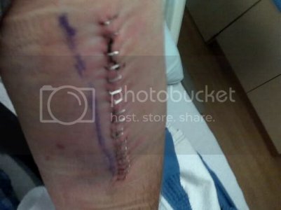 Arm1